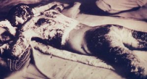 photo: body of a burn victim