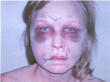 Here is a photo of the injuries to Angela Garbarino's face, including a broken nose, cuts on her cheek, two huge black eyes, and bruises around her mouth.