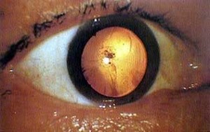 Here is a close-up photo of a survivor's eye blanked out by retinal burning, a common effect of the flash of light and radiation during the atomic bombing of Hiroshima.