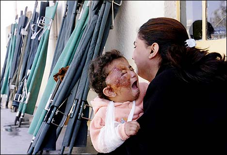 Photo: a severely burned infant crying in its mother's arms